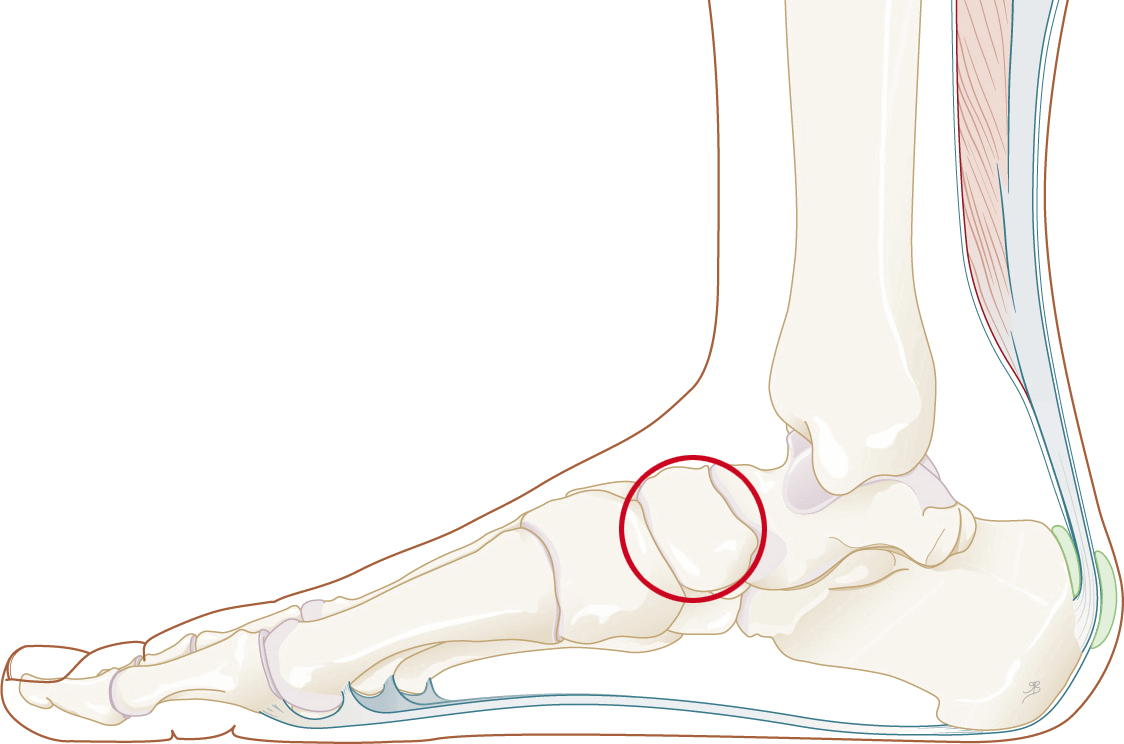 Een naviculare fractuur is een breuk van het scheepvormig been